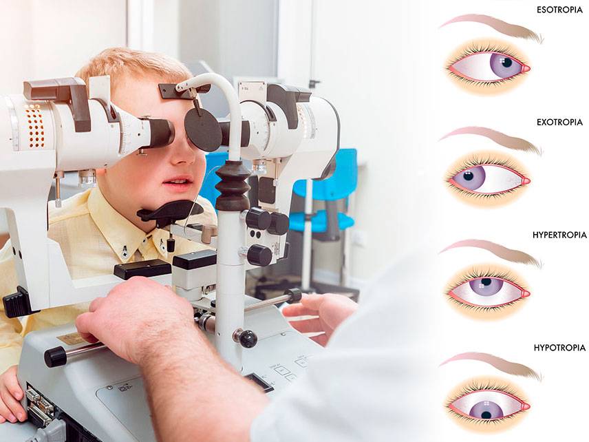 What is the main cause of strabismus?