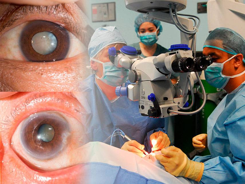 Symptoms Cataract - causes, diagnosis and treatment.